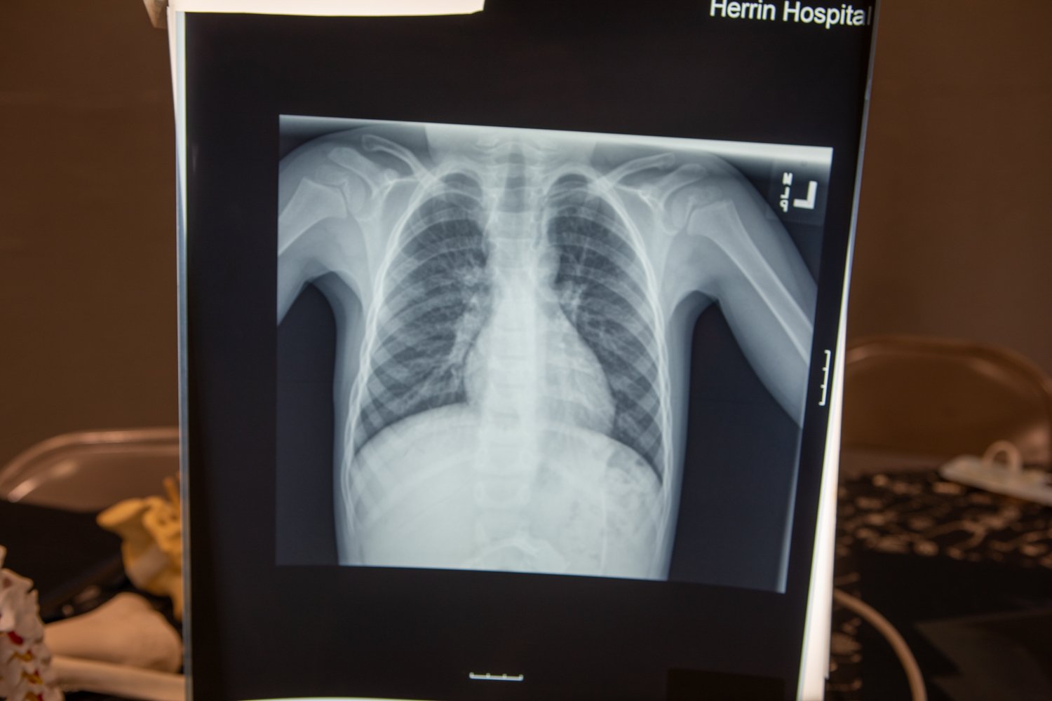 A black-and-white chest X-ray of a person is displayed on a lit screen. The image clearly shows the rib cage, lungs, spine, and shoulders.  The X-ray is being shown in an indoor setting, likely for a demonstration, as part of a skeletal model is visible in the bottom left corner. In the top right corner of the screen, the words "Herrin Hospital" are partially visible.